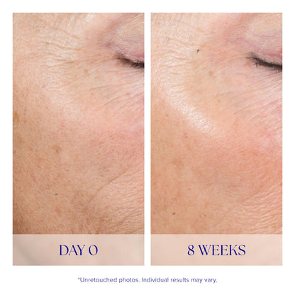 iS CLINICAL Active Peel System 15 treatment kits set arrangement