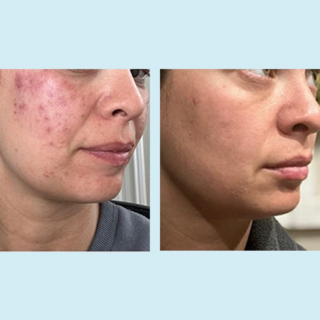 Perfect Image professional strength chemical peel for fine lines and hyperpigmentation