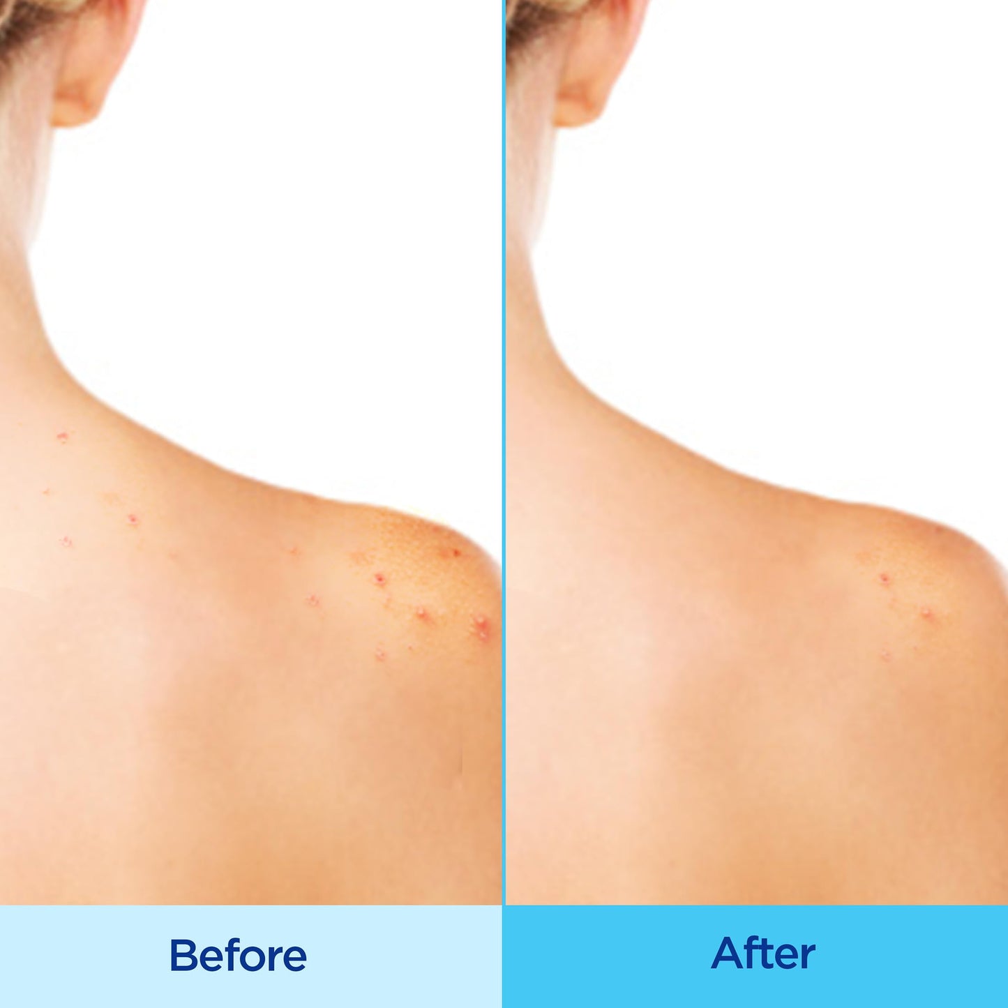Differin Acne-Clearing Body Spray showing the three hundred and sixty degree continuous mist application design