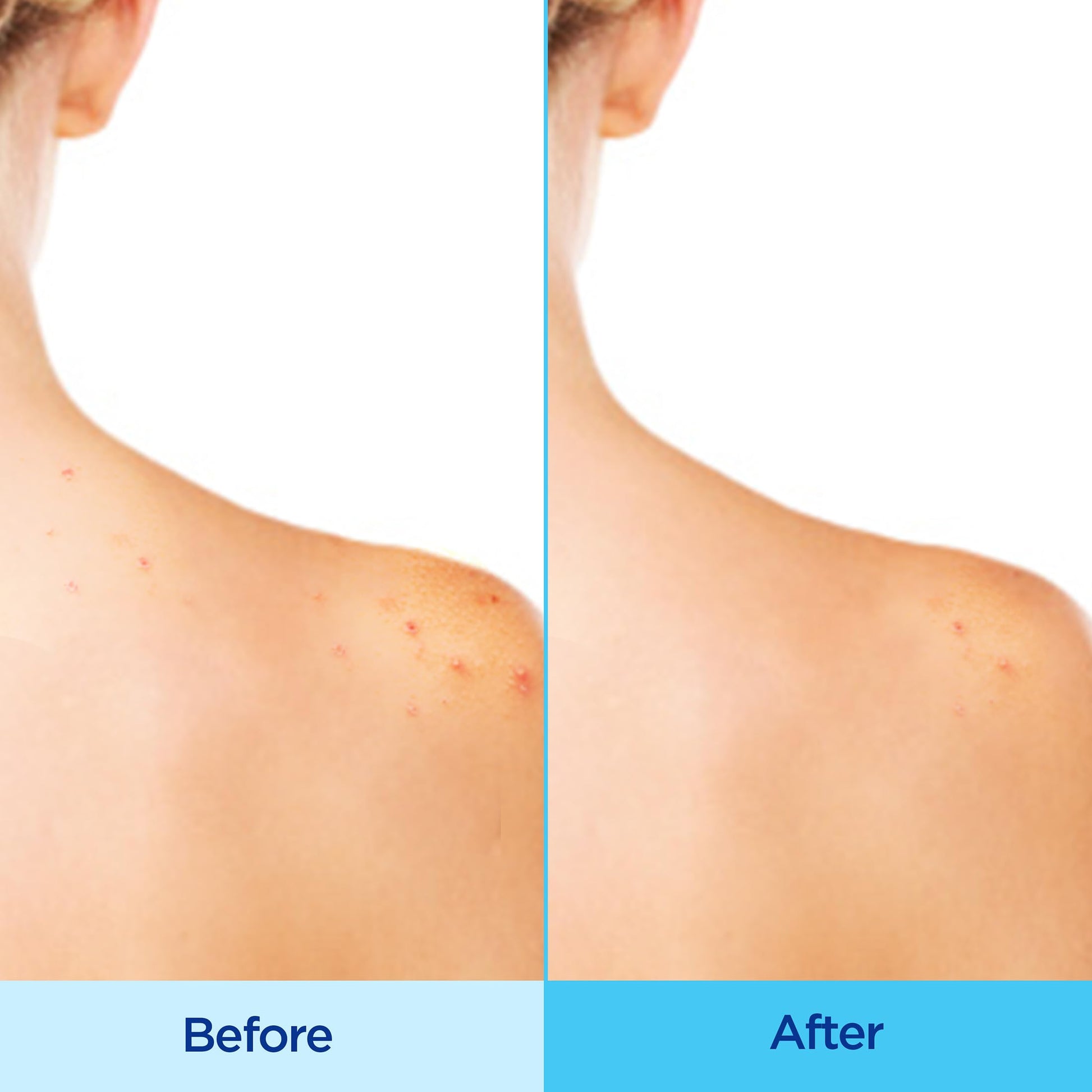Differin Acne-Clearing Body Spray showing the three hundred and sixty degree continuous mist application design