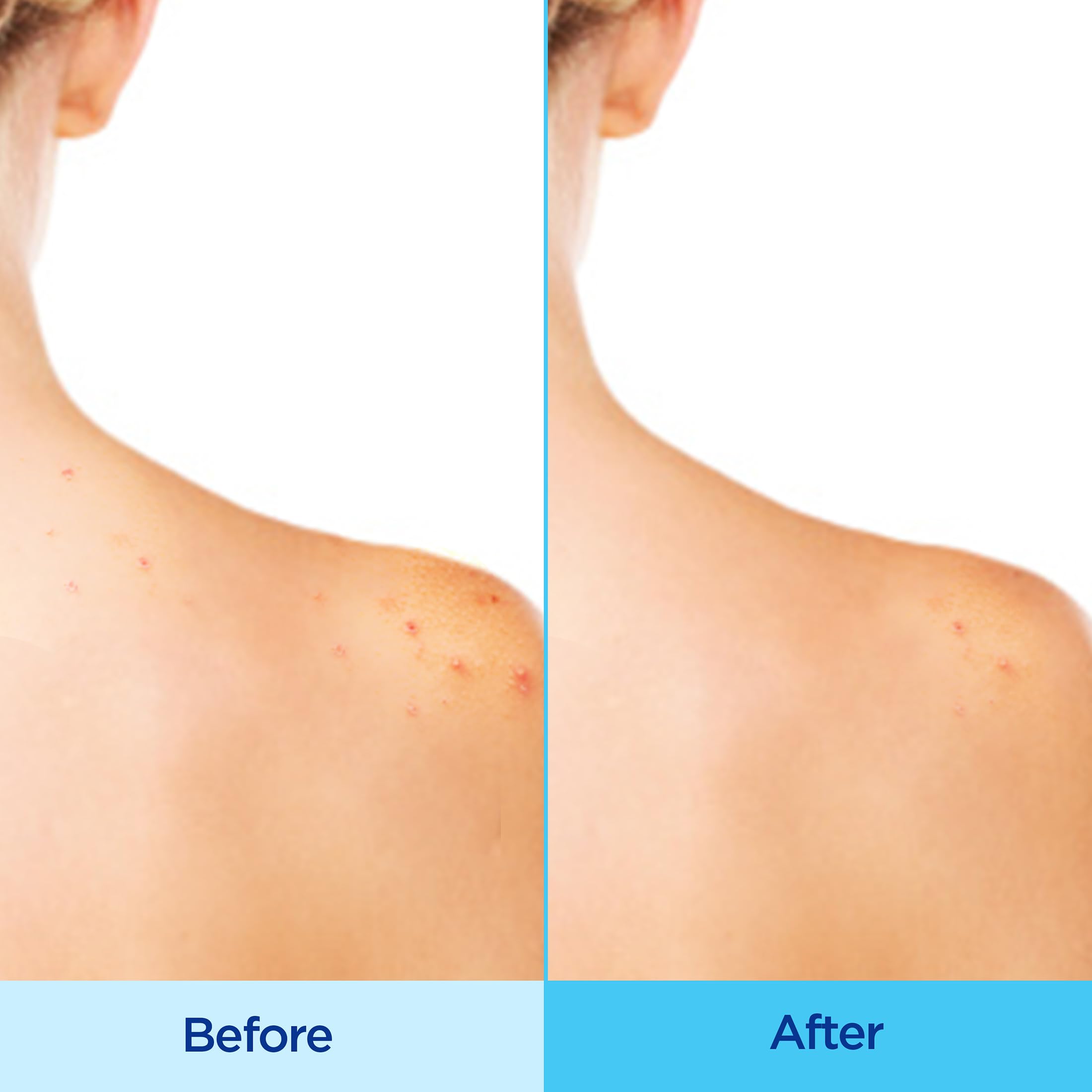 Differin Acne-Clearing Body Spray showing the three hundred and sixty degree continuous mist application design