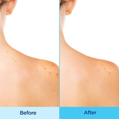 Differin Acne-Clearing Body Spray showing the three hundred and sixty degree continuous mist application design
