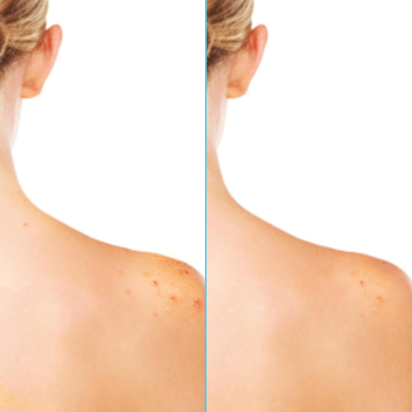 Differin Acne Body Spray bottle placed upright illustrating the lightweight fast drying texture