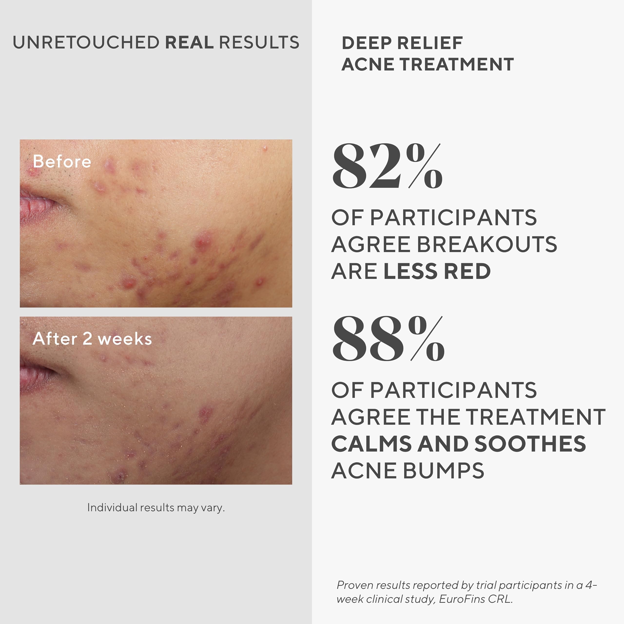 Murad Deep Relief Acne Treatment application on skin demonstrating invisible liquid patch