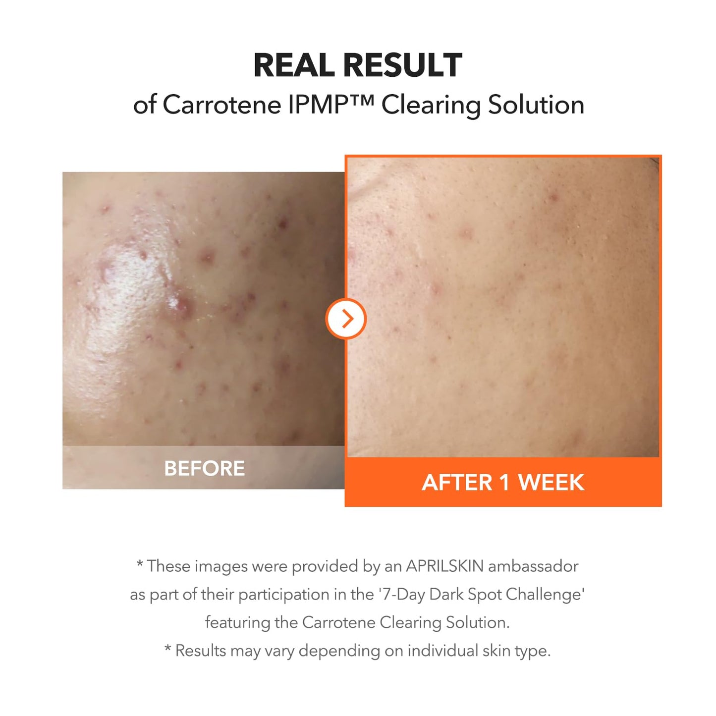 APRILSKIN non comedogenic acne spot gel for sensitive skin