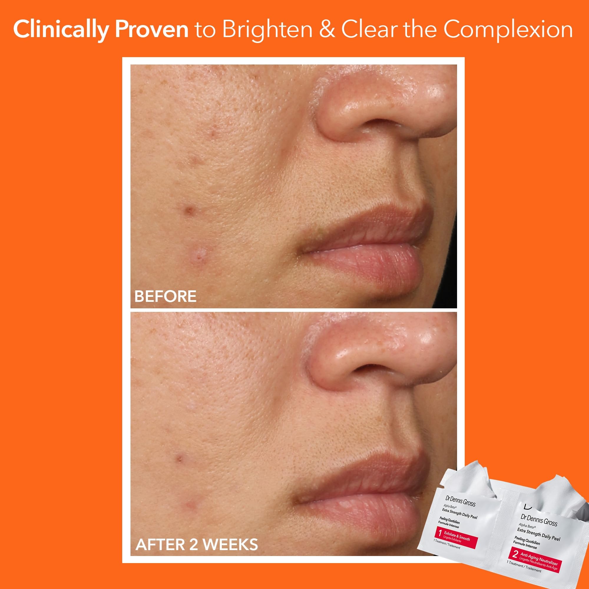 Dermatologist formulated Alpha Beta extra strength daily peel pads for oily skin treatment