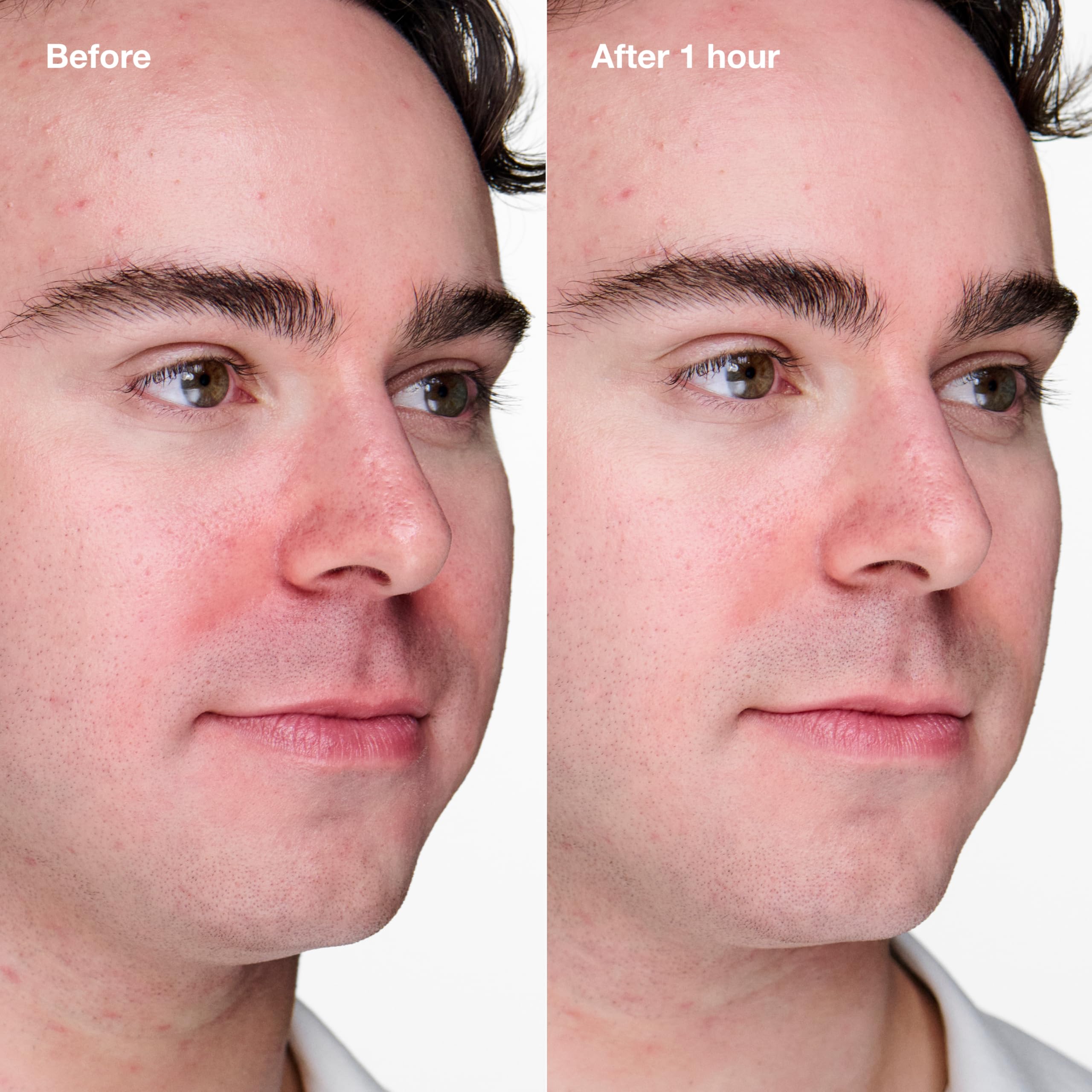 Clinique Clinical Clearing Gel for dry to oily skin
