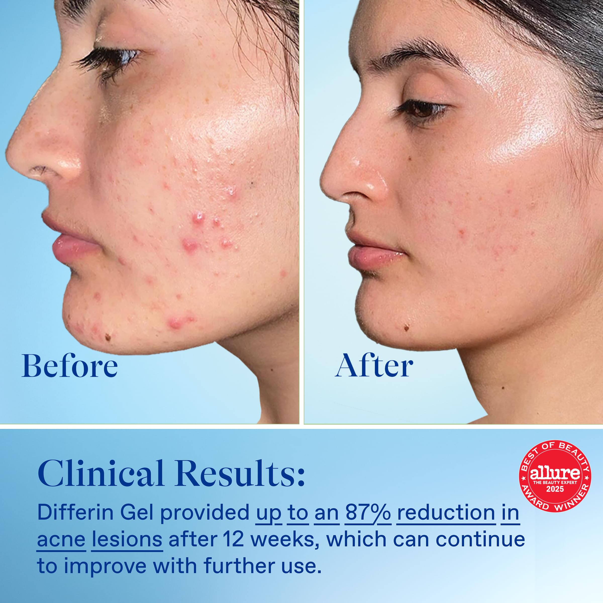Differin acne gel for sensitive skin application