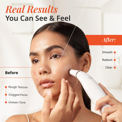 Vanity Planet Exfora facial cleanser wand showing medical-grade diamond tips