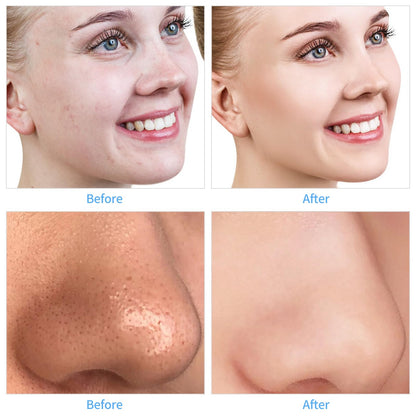 Detail shot of the diamond grit surface on the professional exfoliating attachment heads