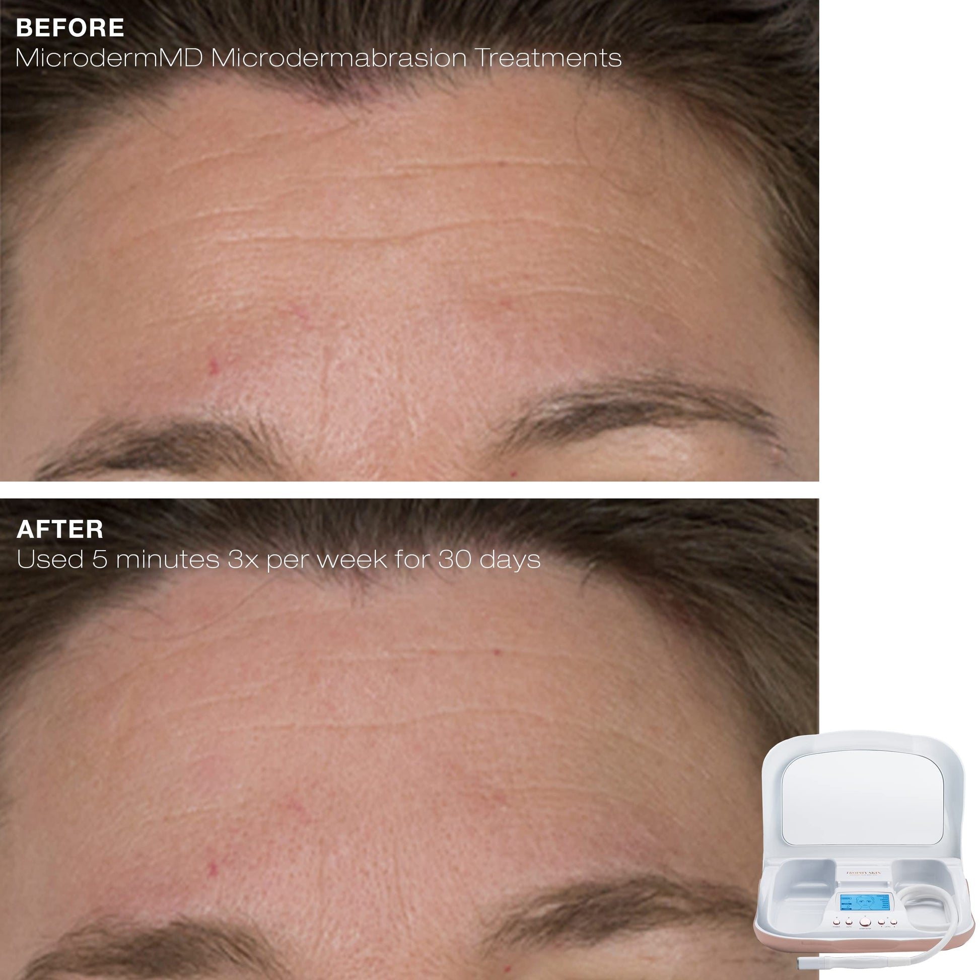 Side view of the Trophy Skin premium at home facial resurfacing system