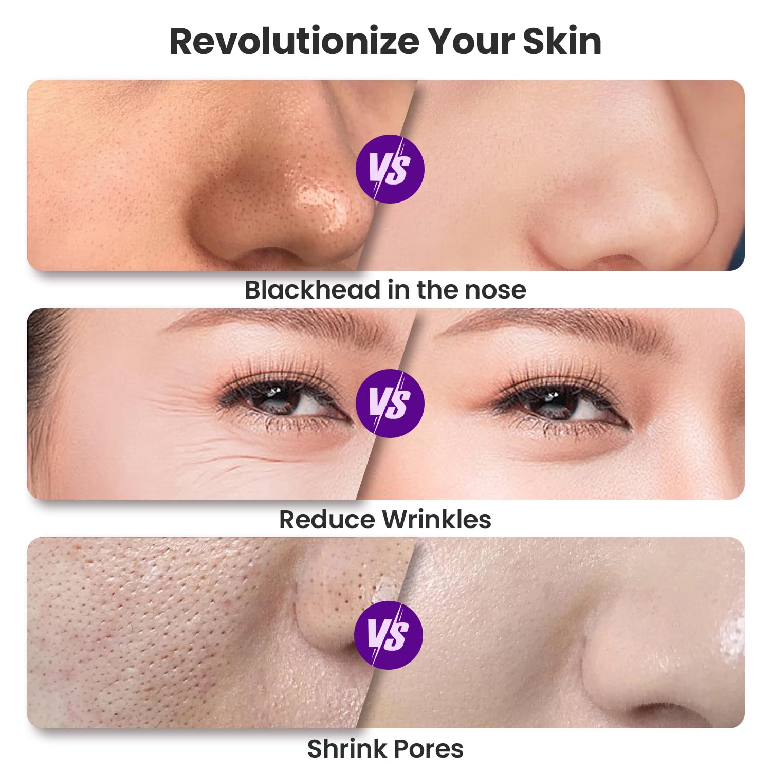 Close-up view of the diamond-tipped applicator gently exfoliating skin for blackhead and dead skin removal.