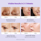 Demonstration of the microdermabrasion wand applied for blackhead removal and pore cleansing