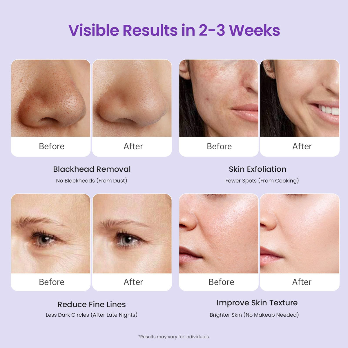 Demonstration of the microdermabrasion wand applied for blackhead removal and pore cleansing