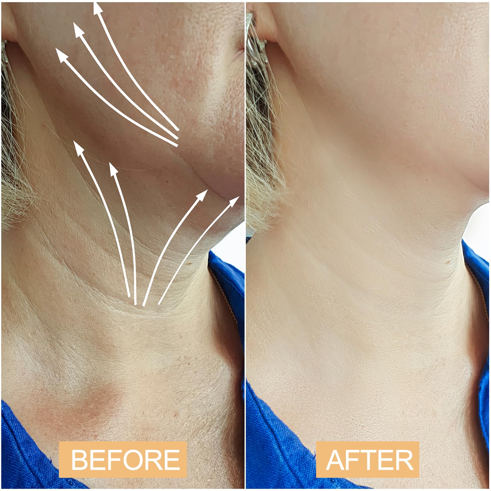 Side profile showing the application process of the breathable neck tightening tape onto clean dry skin for an instant lift
