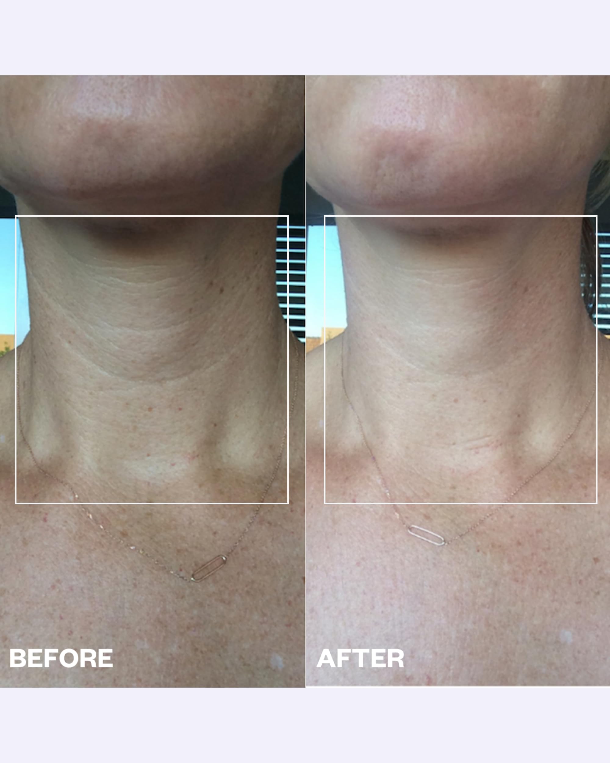 Side view of Wrinkles Schminkles medical grade silicone neck pad