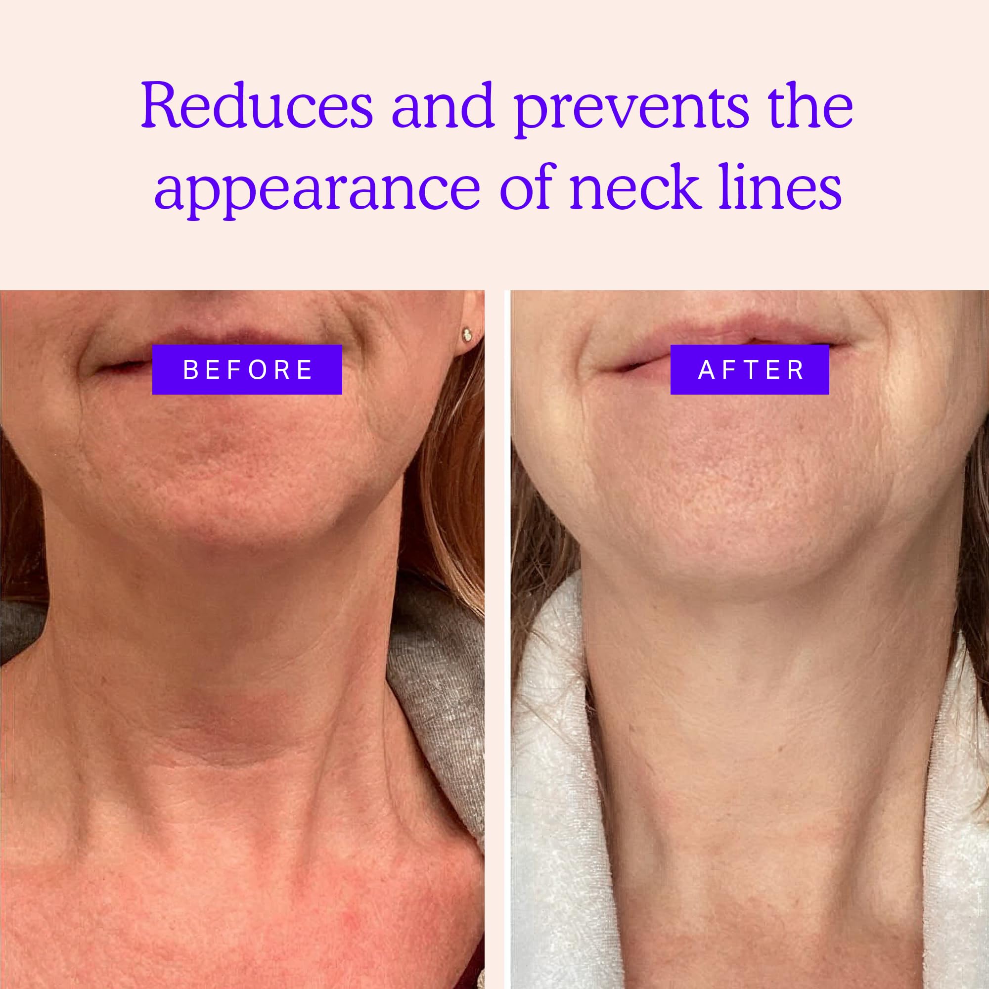 Blumbody silicone neck pads applied to neck for firming