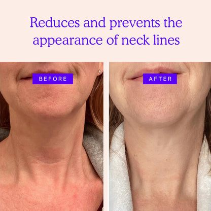 Blumbody silicone neck pads applied to neck for firming