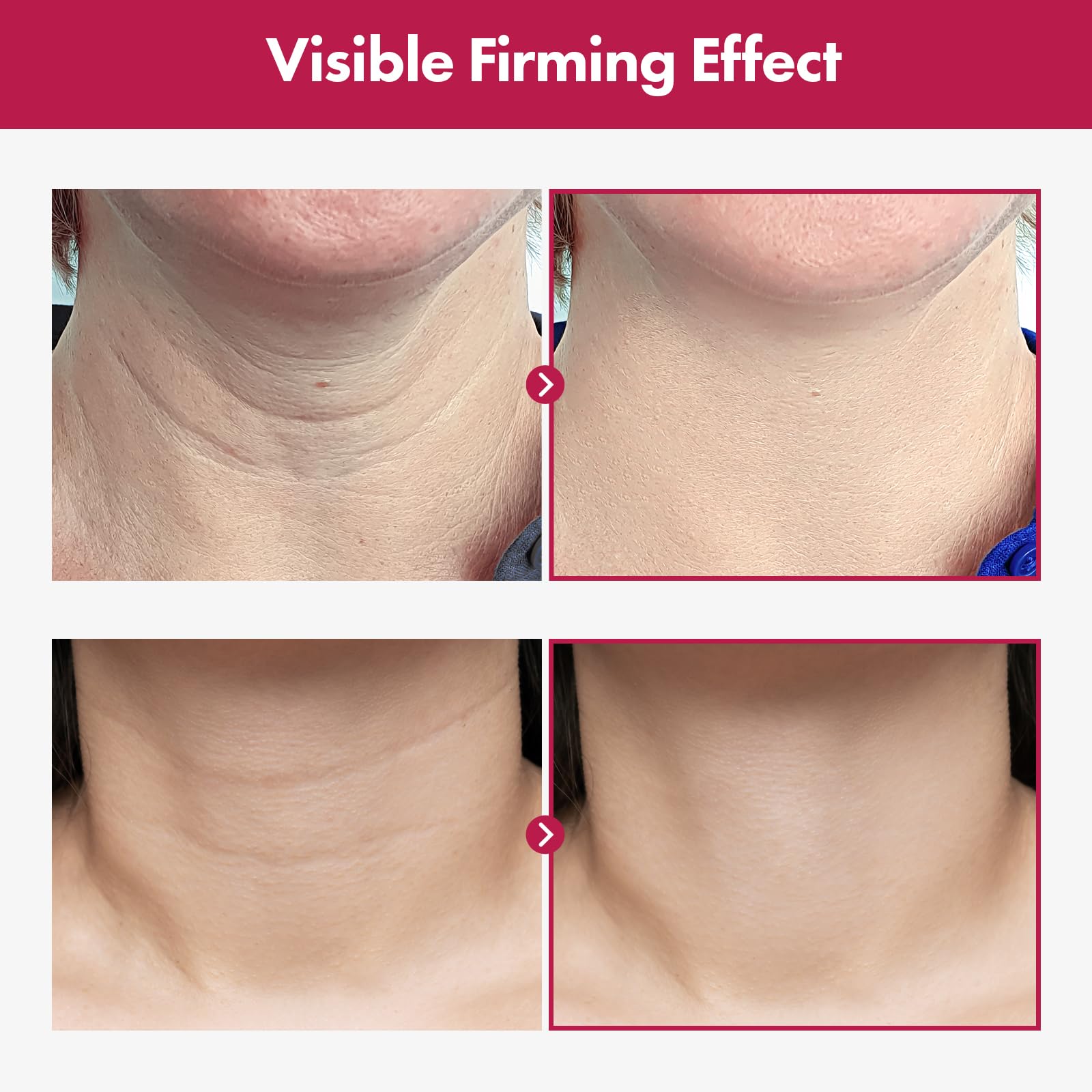 Collagen and hyaluronic acid neck cream application