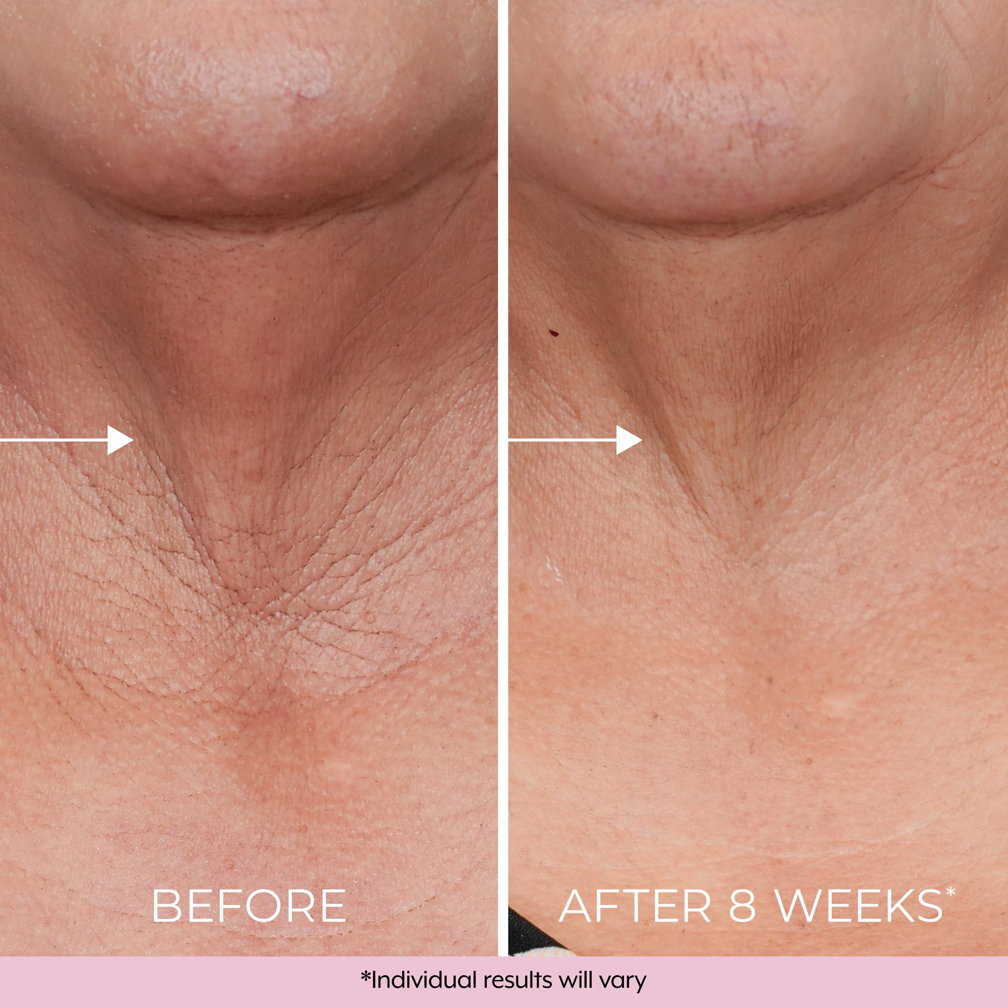 Texture and consistency of Dekliderm retinol neck cream