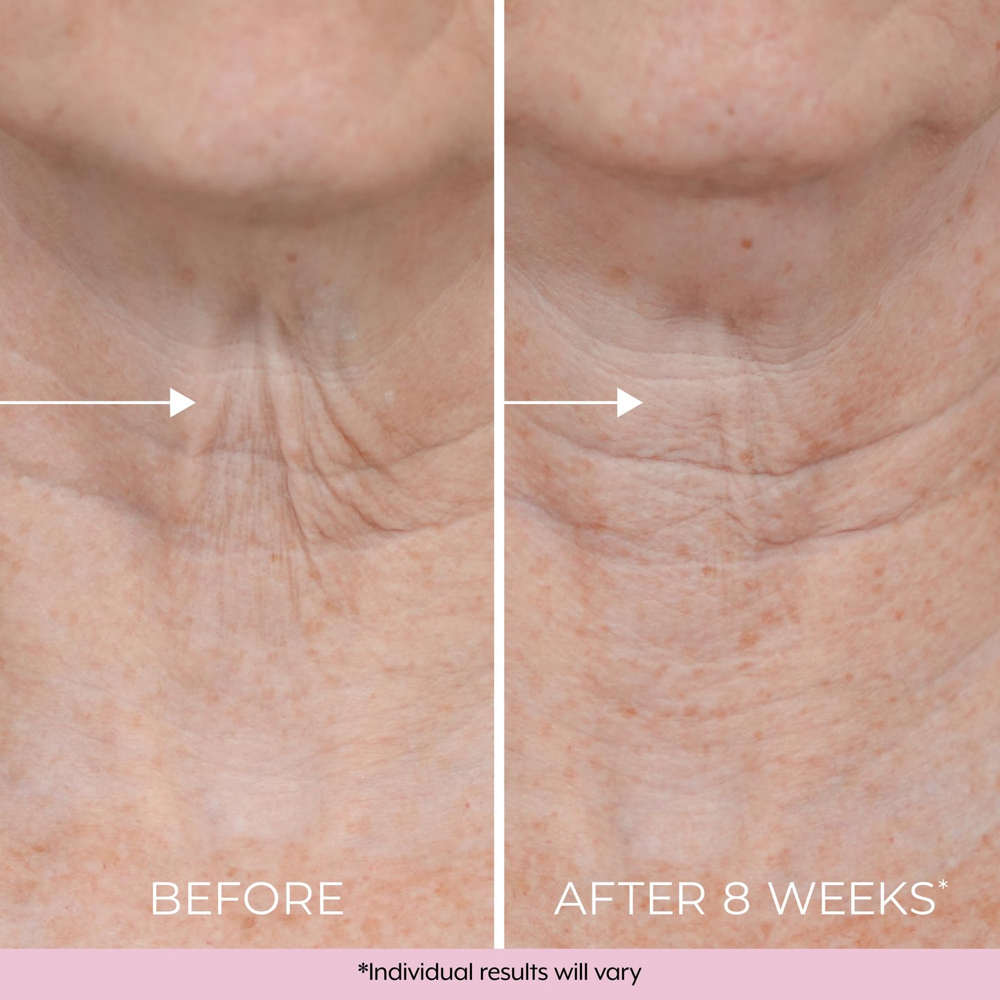 Skincare results after using Dekliderm neck firming cream