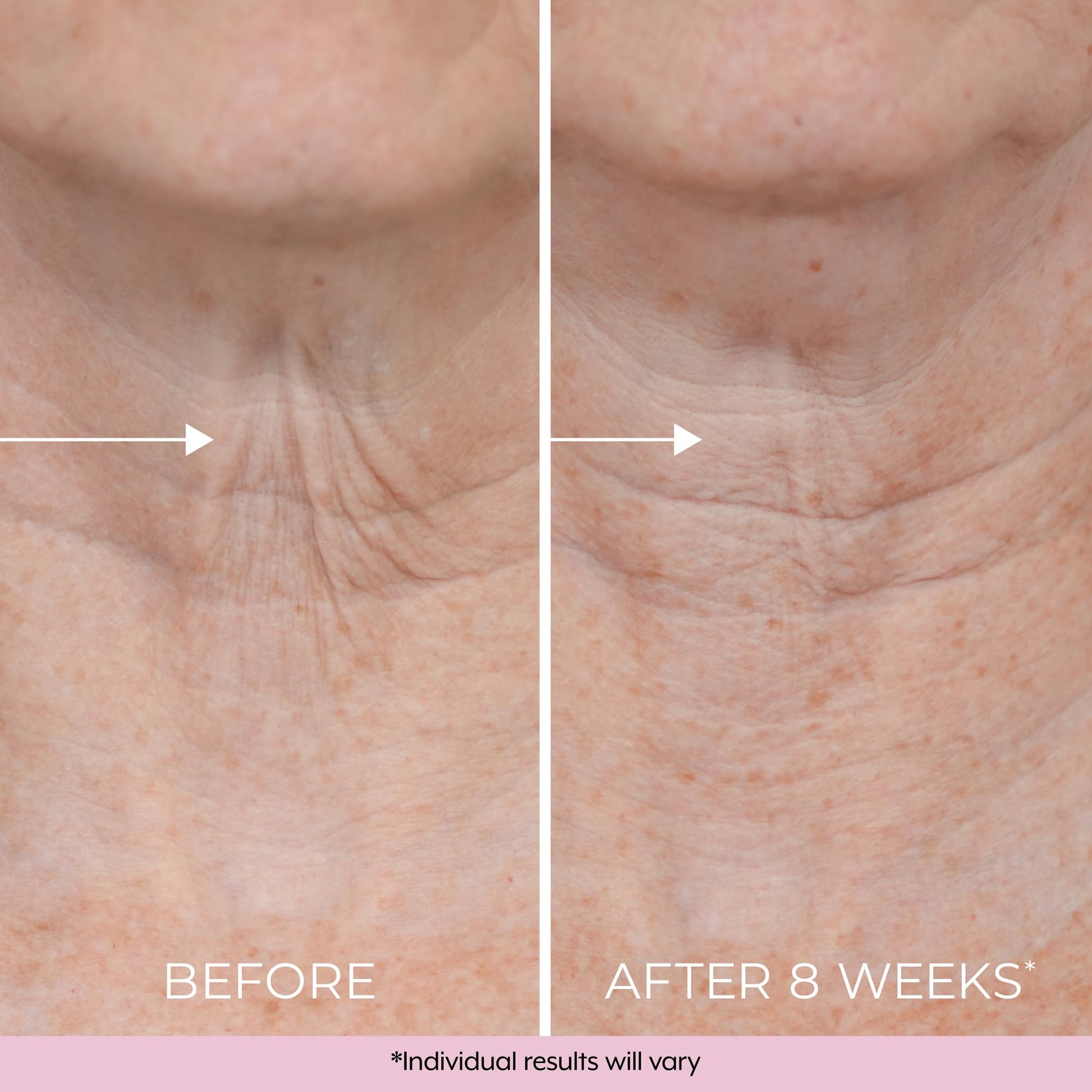 Skincare results after using Dekliderm neck firming cream