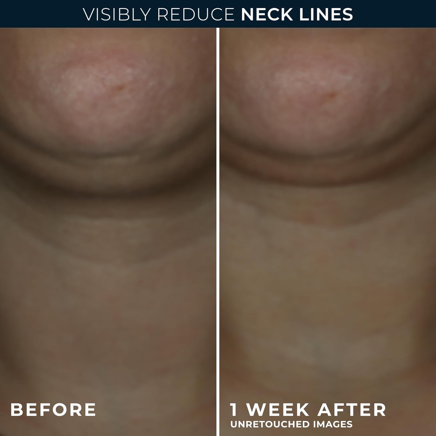 RoC neck cream packaging showcasing advanced retinol and hyaluronic acid