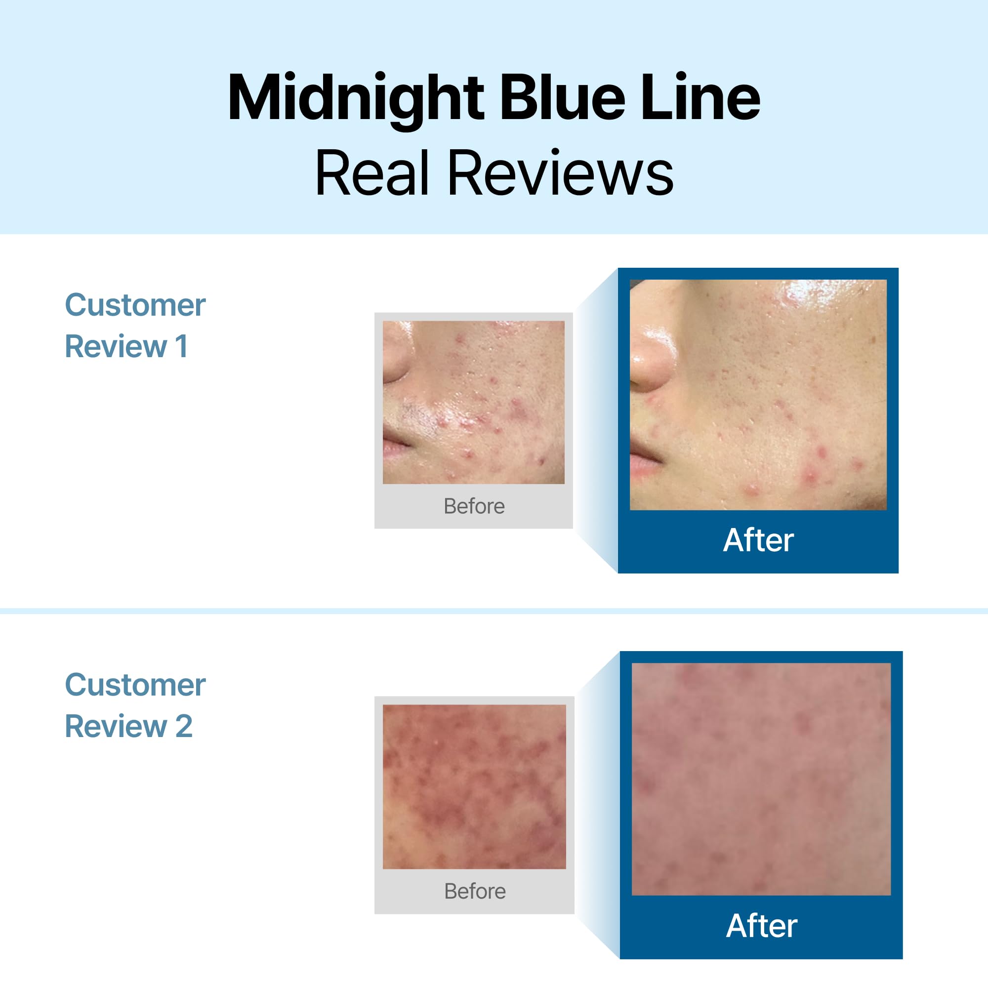 Applying Dear Klairs Midnight Blue Calming Cream to face