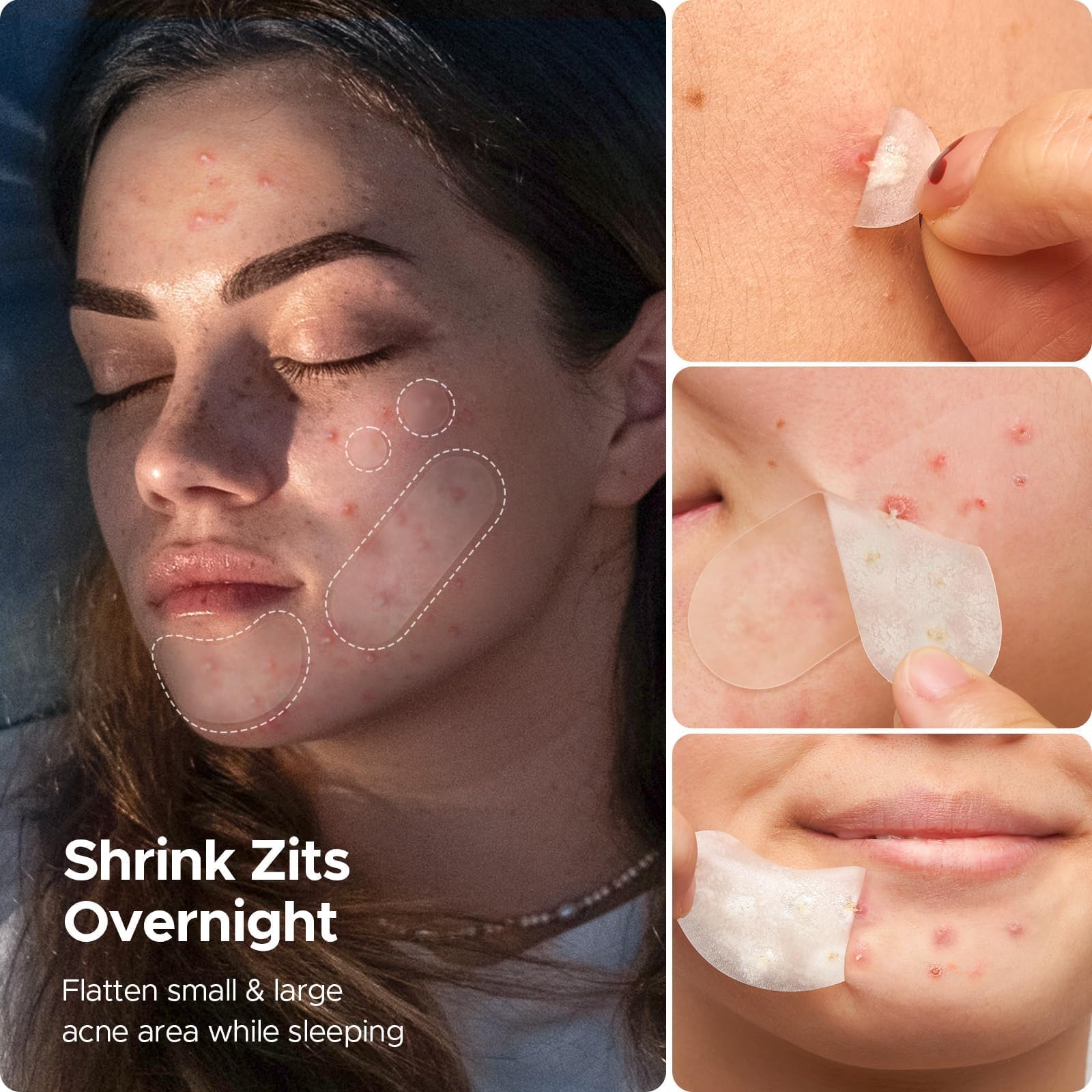 LitBear acne patch transparency demonstration on skin