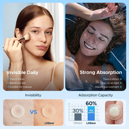 Before and after visual of acne treated with hydrocolloid patches