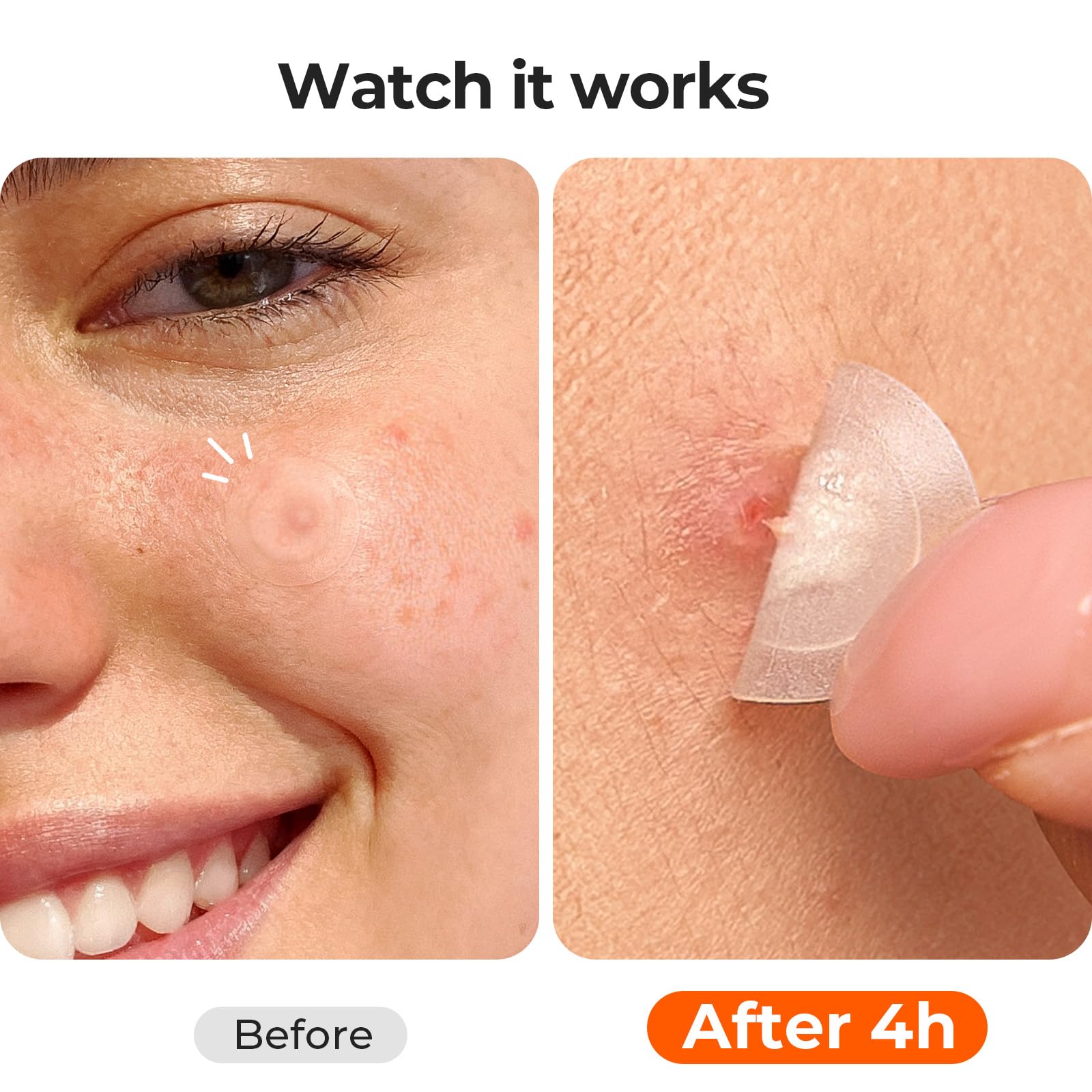 Close up of 0.01cm ultra-thin invisible acne patch on skin