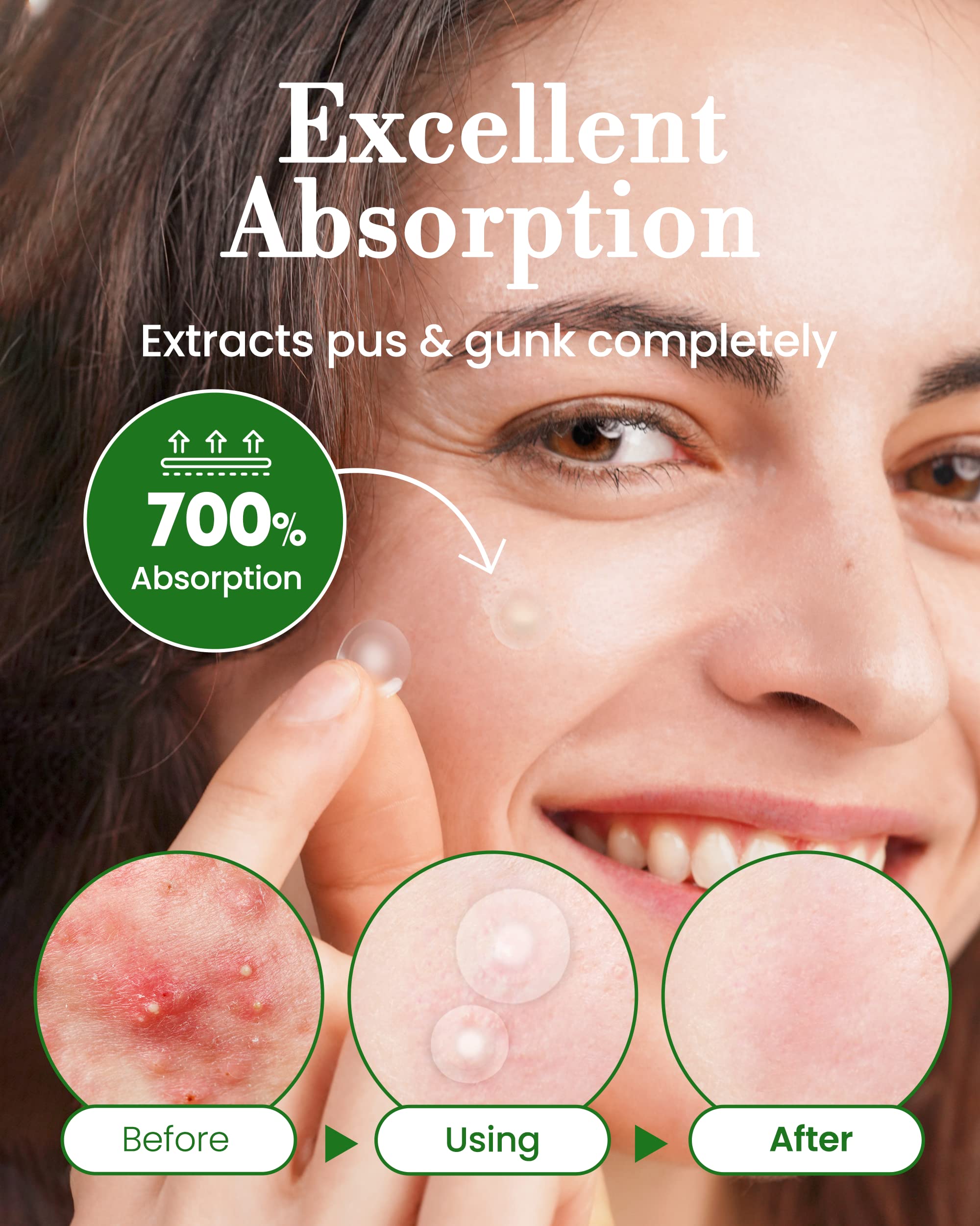 Detailed graphic demonstrating the high absorption hydrocolloid technology drawing out pimple impurities