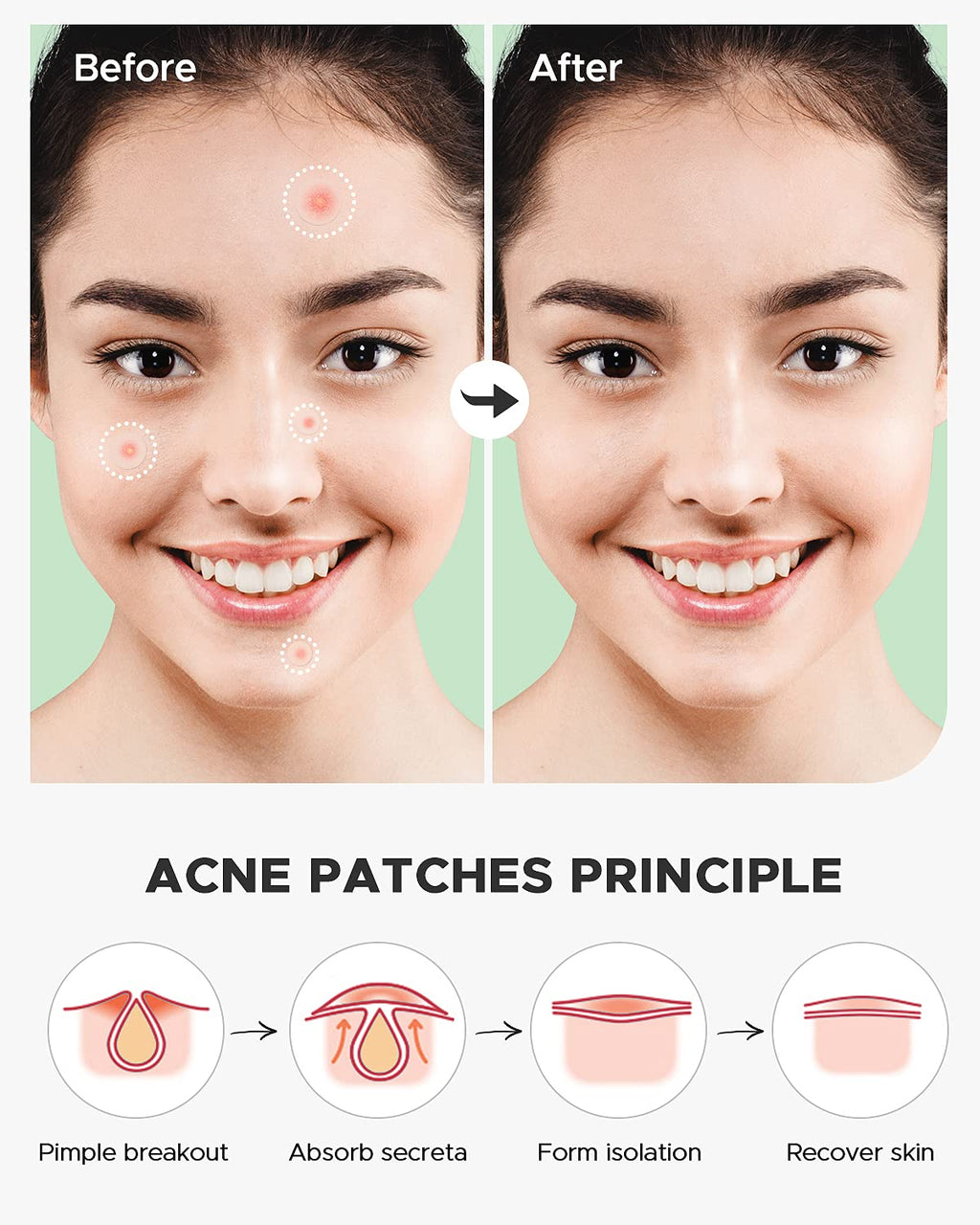 ZATKTK Hydrocolloid acne sticker applied invisibly on face