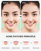 ZATKTK Hydrocolloid acne sticker applied invisibly on face