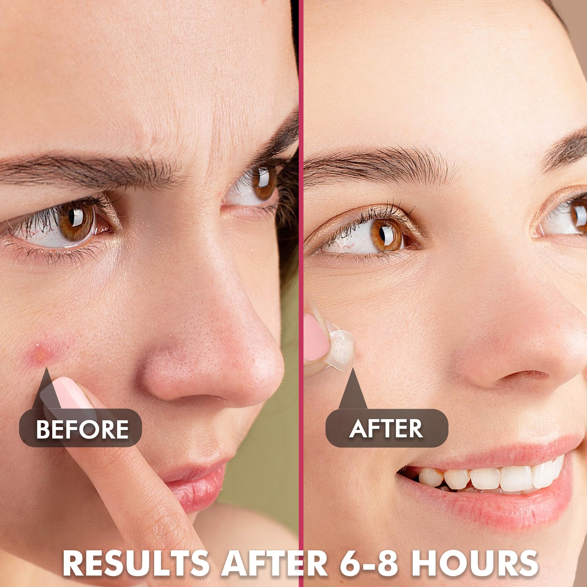 Close up of plain hydrocolloid acne stickers on perforated easy peel sheets in ten millimetre and twelve millimetre sizes