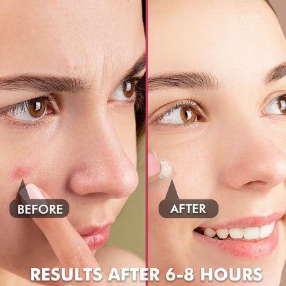 Close up of plain hydrocolloid acne stickers on perforated easy peel sheets in ten millimetre and twelve millimetre sizes