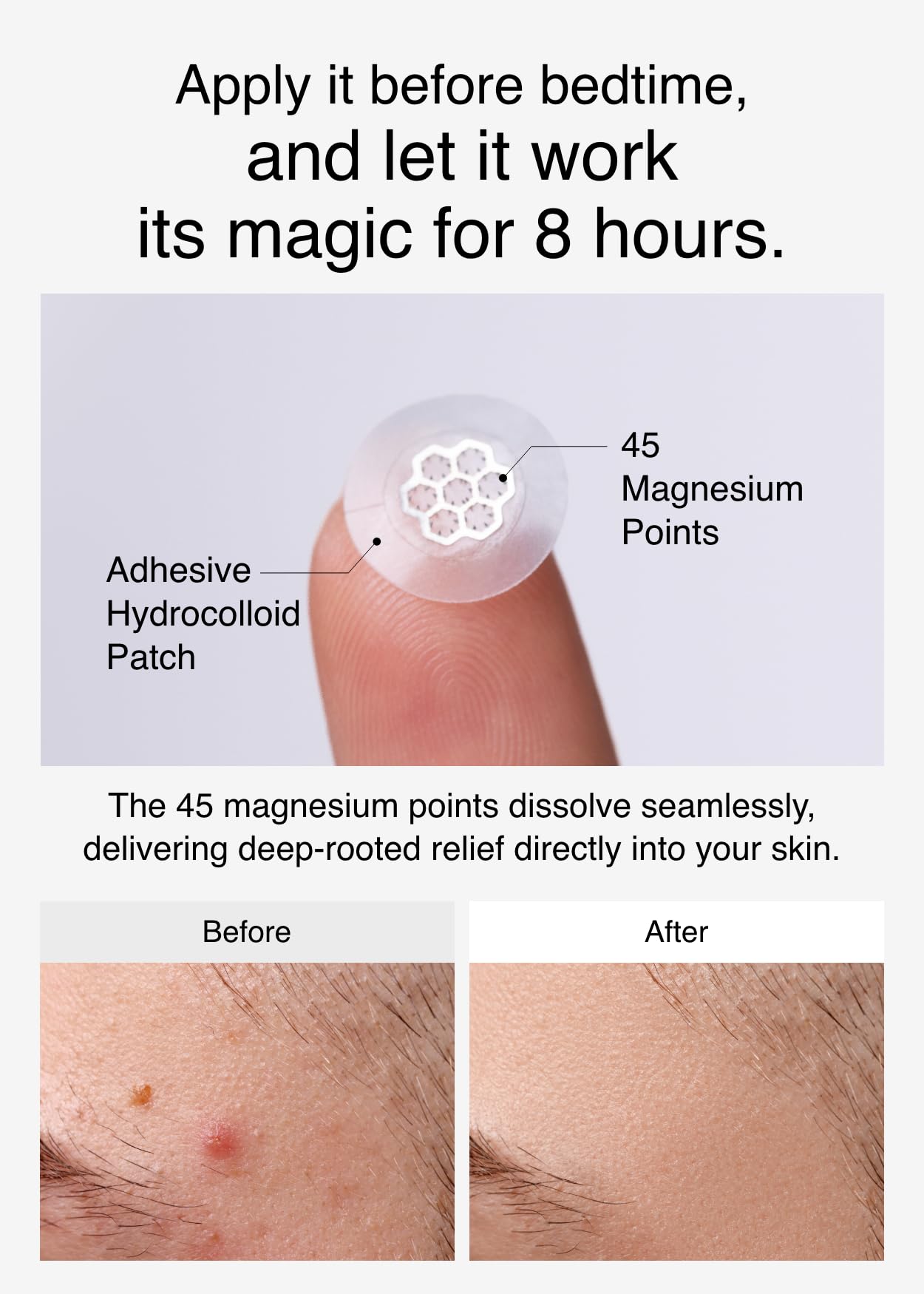 Close-up of DWEasyDerm microdot zit sticker designed for deep blemish recovery.