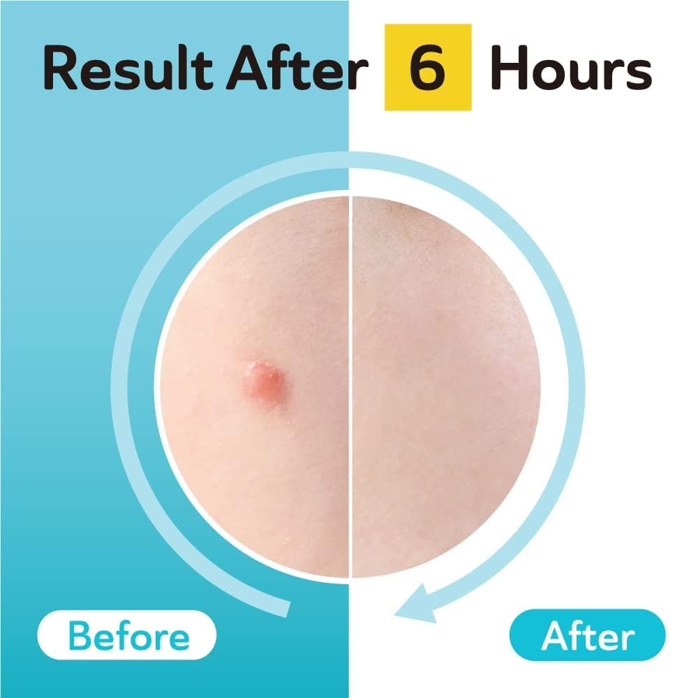 Skincare routine layout featuring the imported Derma Angel ninety six count single size blemish patches.