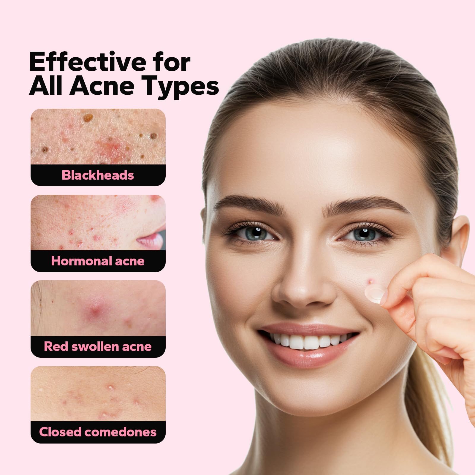 CharmCherry hydrocolloid pimple patches being applied to an early stage deep facial zit.