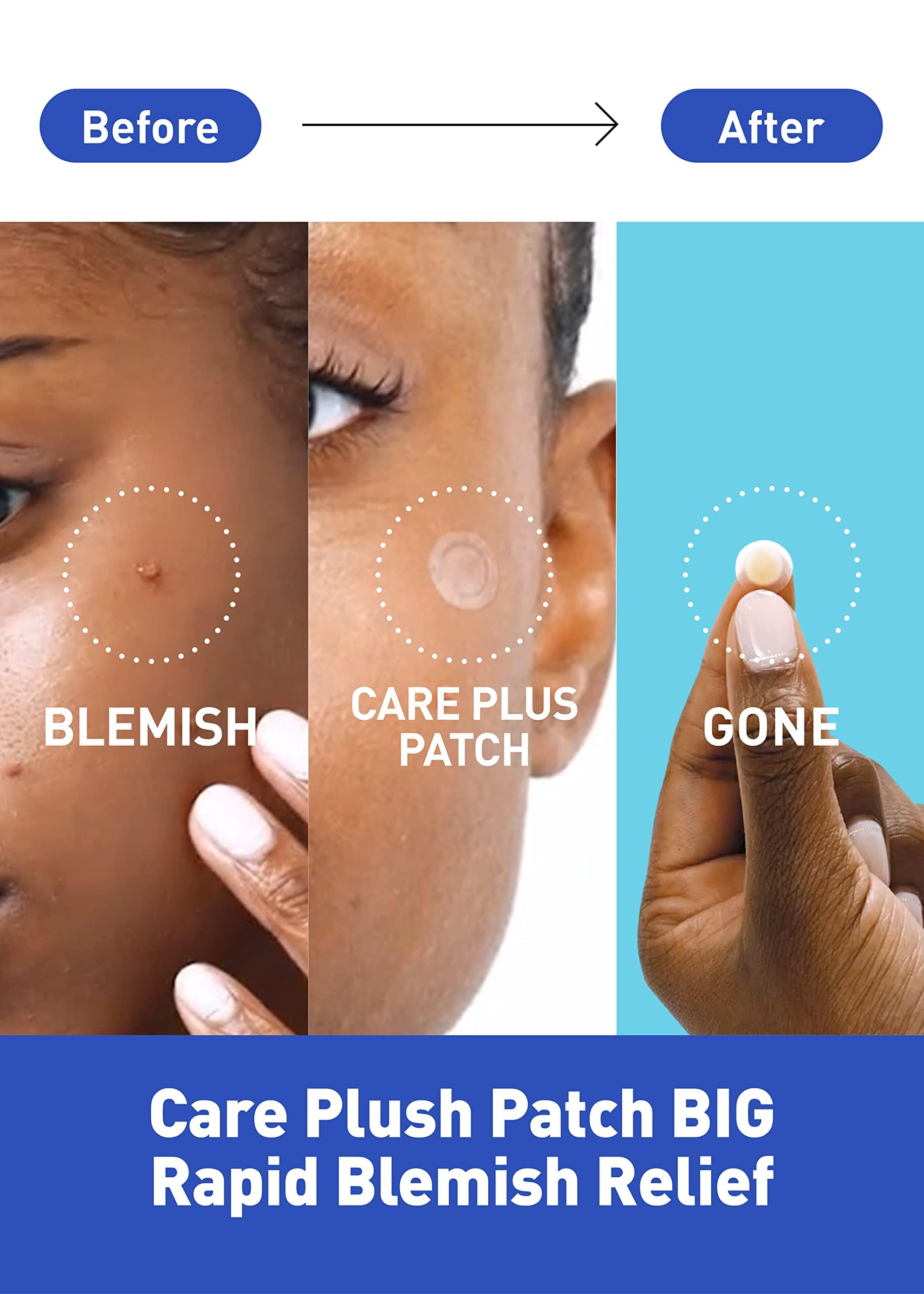 Waterproof acne cover stickers applied discreetly on facial skin for pimple care