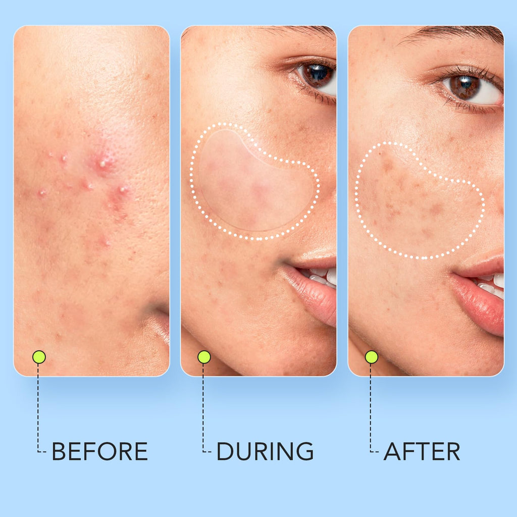 LitBear body acne patches shown on back and neck
