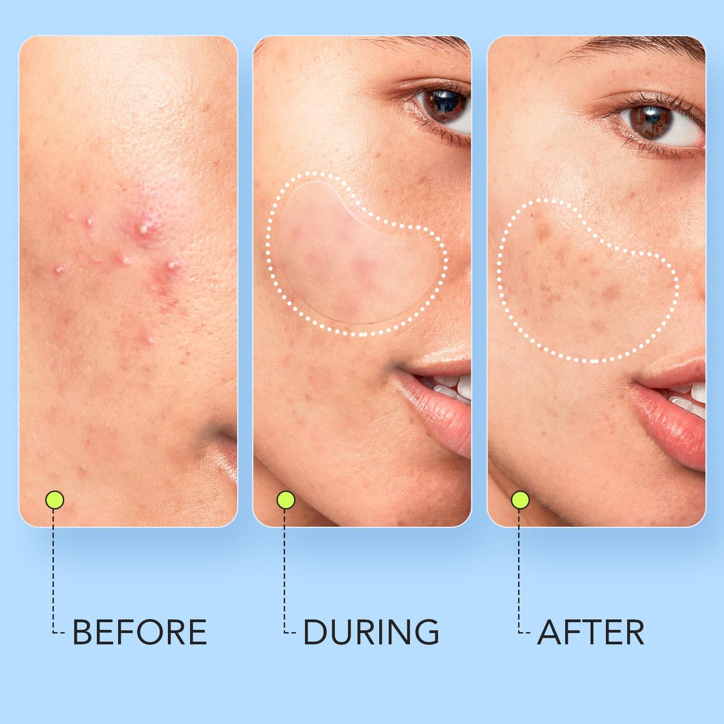 LitBear extra large hydrocolloid sheet applied to a skin breakout on the forehead area.
