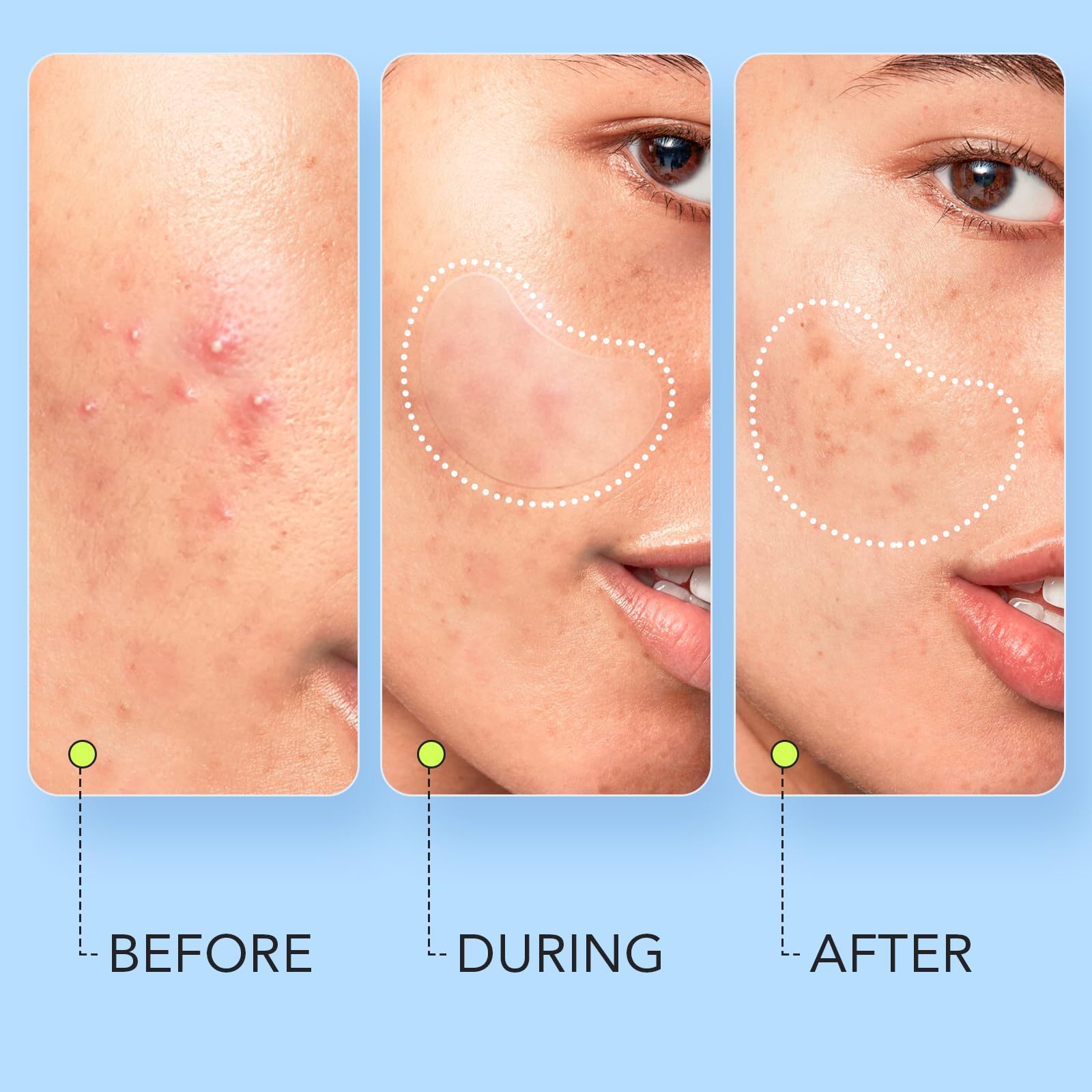LitBear extra large hydrocolloid sheet applied to a skin breakout on the forehead area.