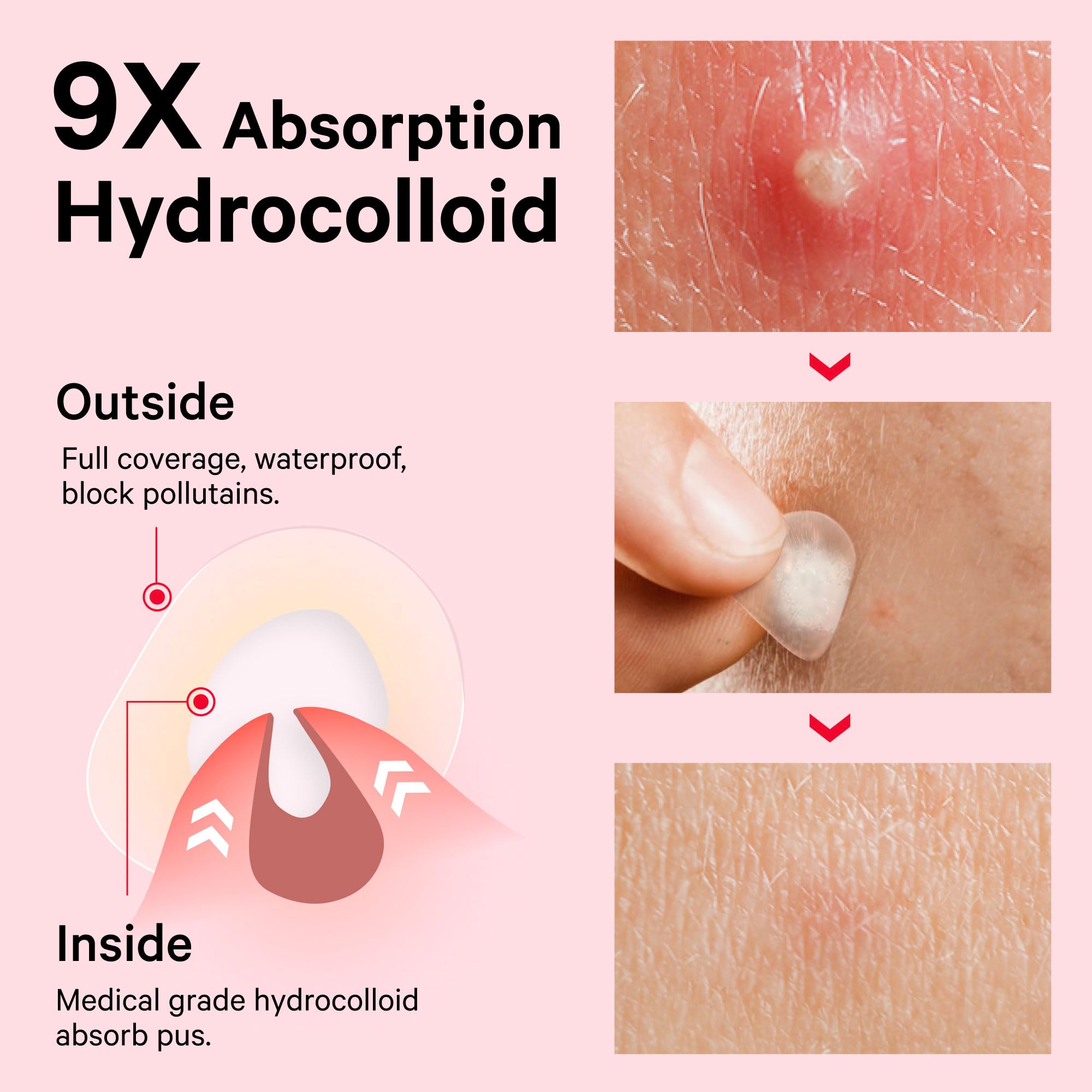 Close up of individual hydrocolloid blemish patches containing salicylic acid and tea tree oil ingredients.