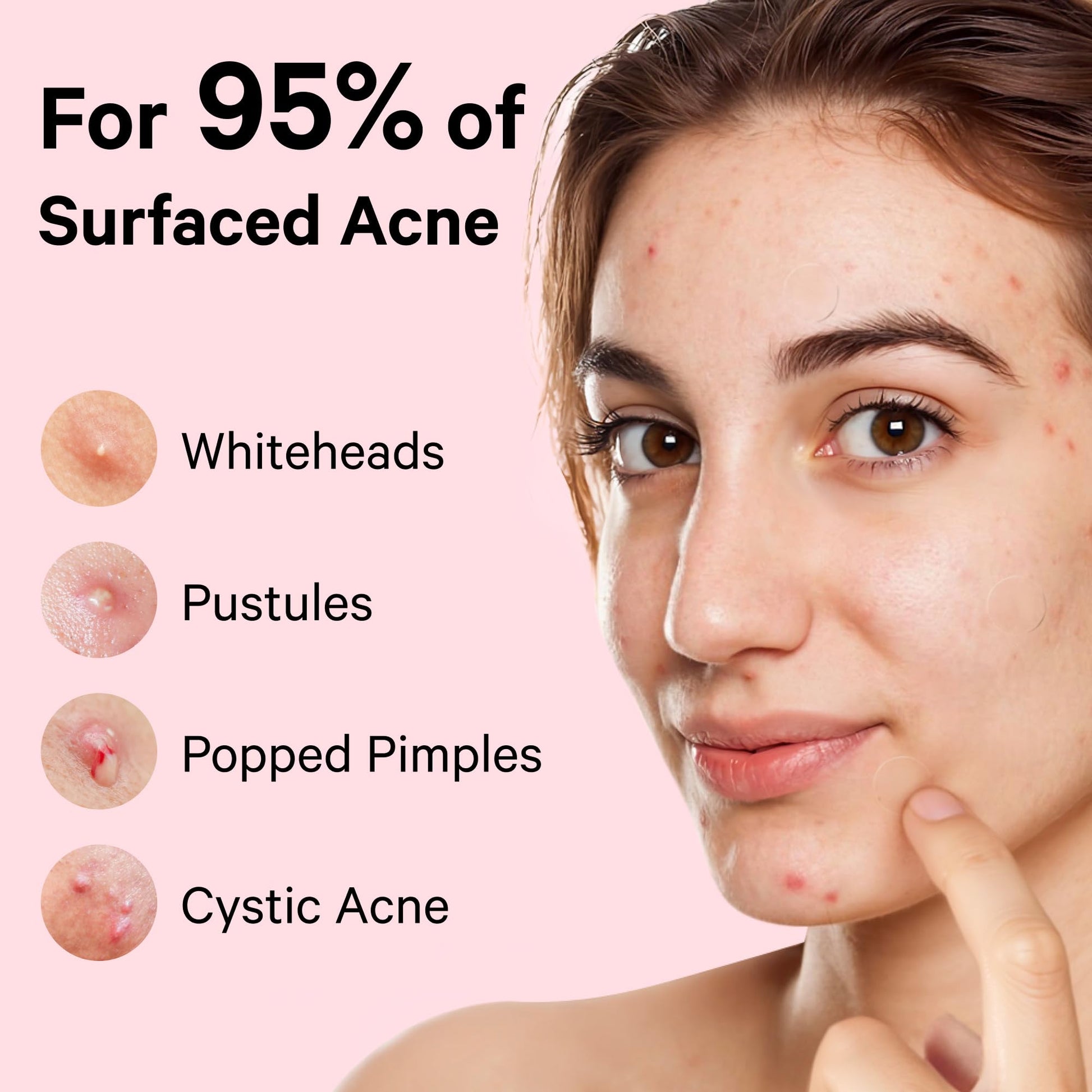 Demonstration of the central gunk absorption layer pulling impurities out of a skin breakout.