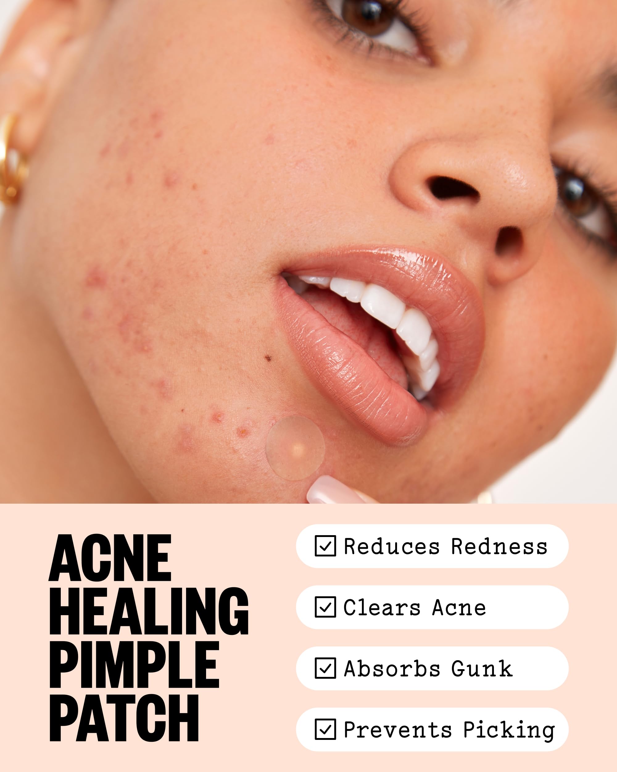 Peace Out hydrocolloid acne spot treatment dots with salicylic acid and retinol.