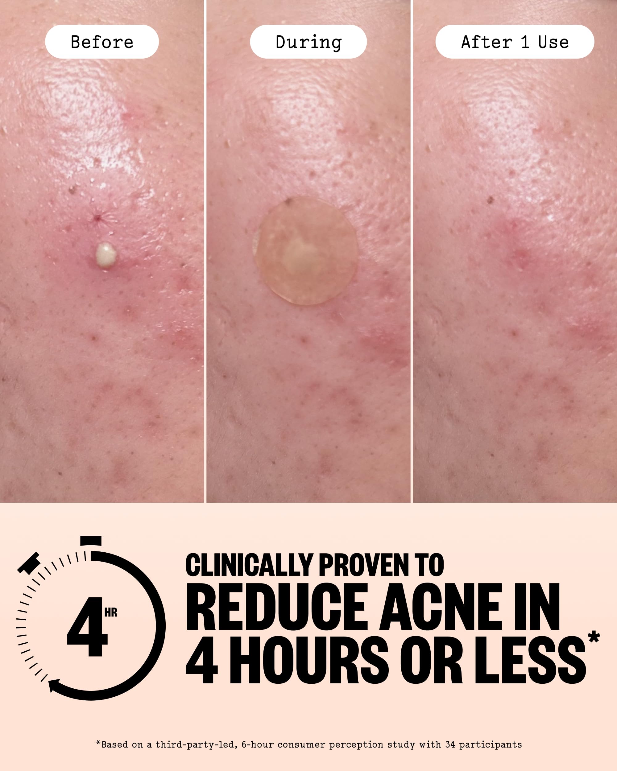 Close up of Peace Out blemish patches showing the circular hydrocolloid polymer material.
