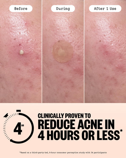 Close up of Peace Out blemish patches showing the circular hydrocolloid polymer material.
