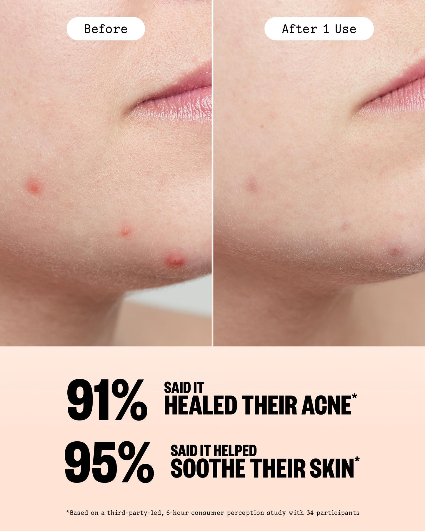 Peace Out forty count jumbo pack pimple patches for fast acting acne care.