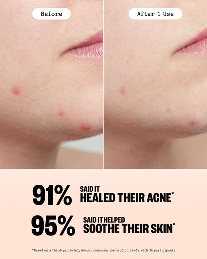 Peace Out forty count jumbo pack pimple patches for fast acting acne care.
